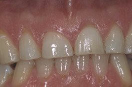 Zahn wird grau wurzelbehandelter Wurzelbehandlung: Wühlen